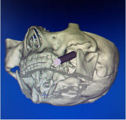 我院外三科科成功完成3D打印导板辅助定位下三叉神经半月节经皮射频热凝术