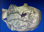 我院外三科科成功完成3D打印導板輔助定位下三叉神經半月節經皮射頻熱凝術